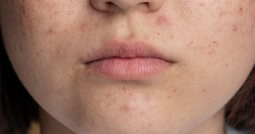 melasma treatment in banashankari, bangalore